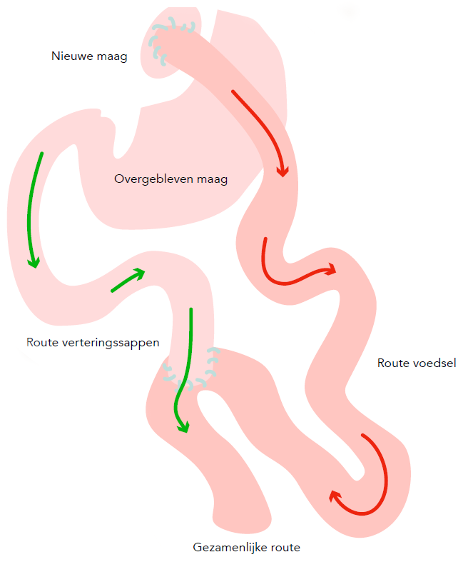 Gastric bypass operatie