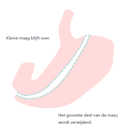 Gastric sleeve operatie